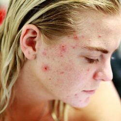 acne cleansing programme