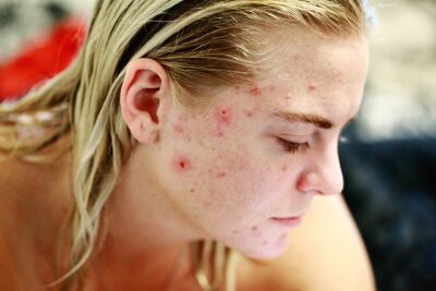 acne cleansing programme